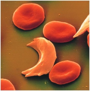 anemia falciforme