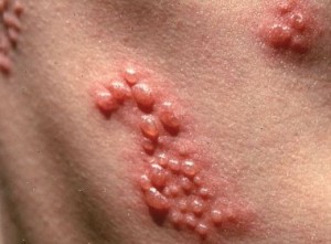 20% da população, em algum momento, apresentará herpes zoster(Foto: Getty Images)