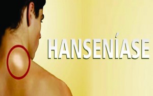 hanseniase
